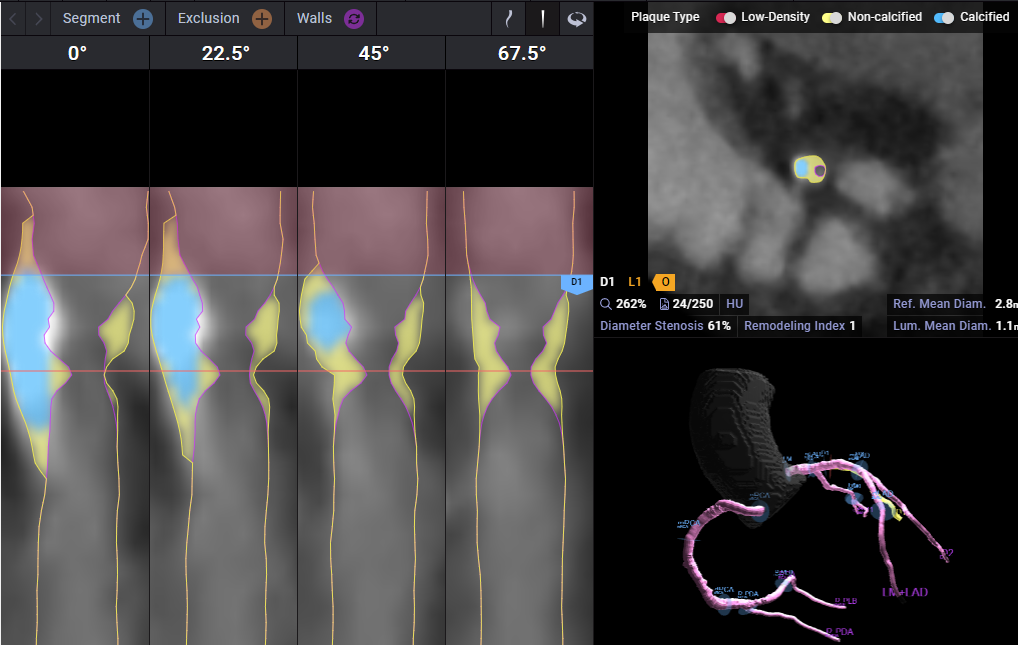 Image showing 61% blockage in a vessel without volatile plaque but with non-calcified plaque.